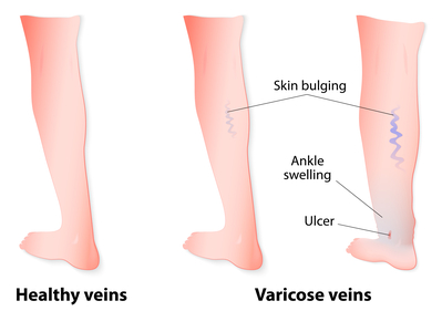 Varicose Veins